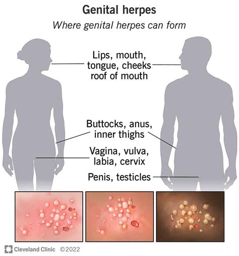 simptome herpes genital|Genital Herpes: Symptoms, Treatment, and Management Guide